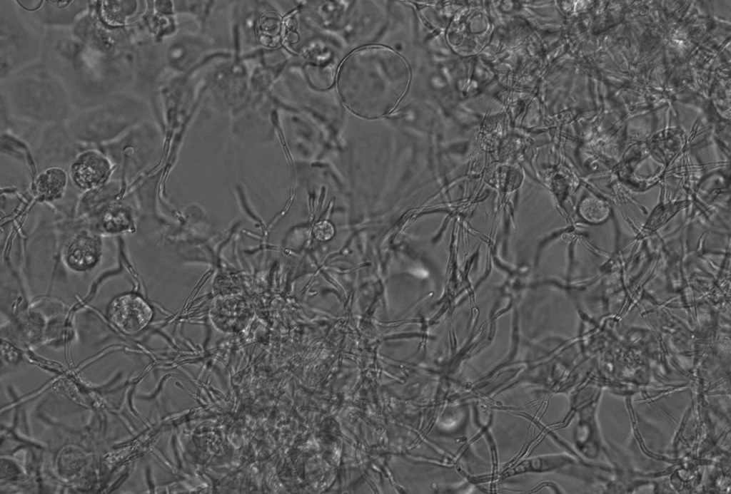 vaginal epithelial monolayer with C albicans infection 1